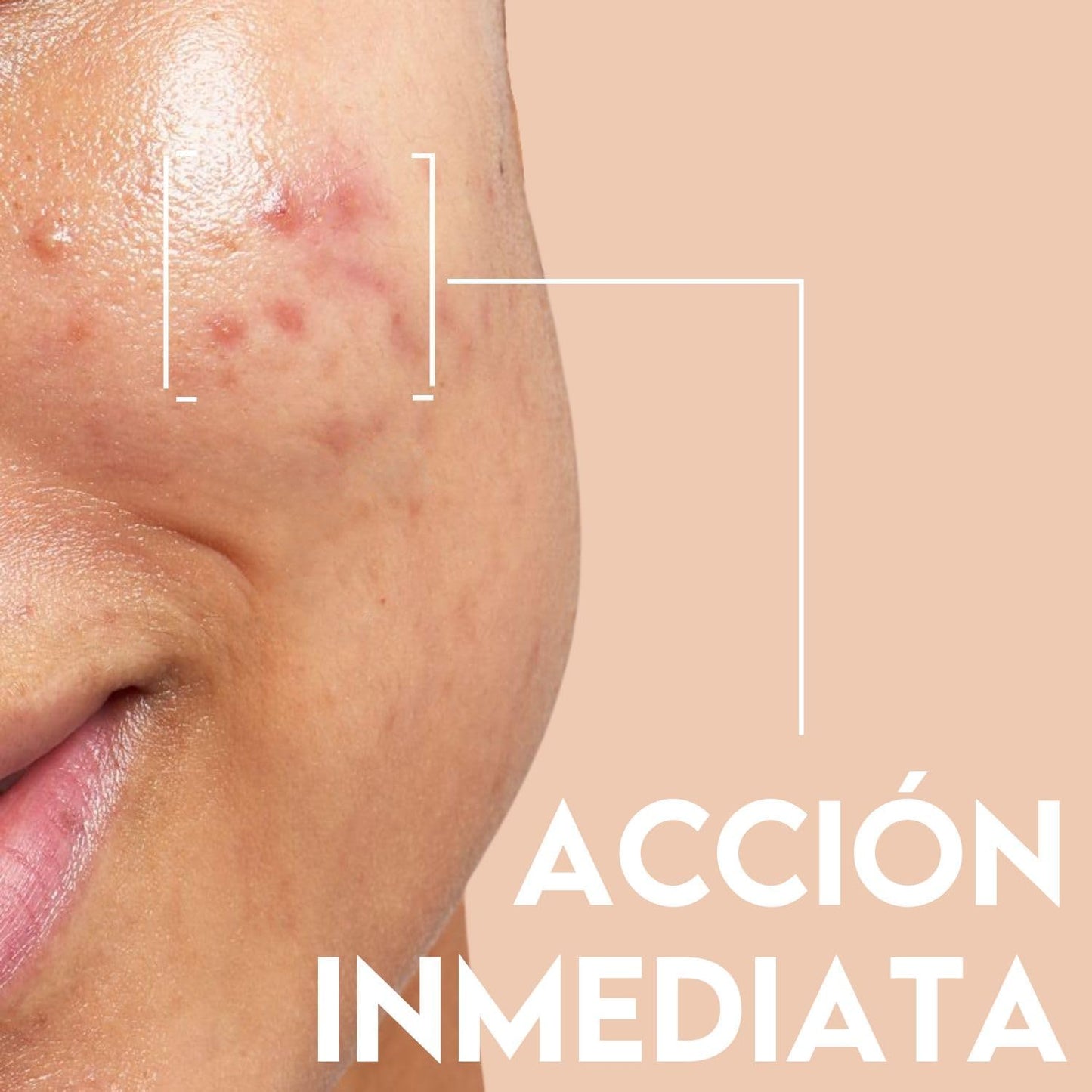 ACNIDUL | Roll-on de ação imediata com ácido glicólico e calêndula | Remova espinhas do seu rosto | 14 ml |