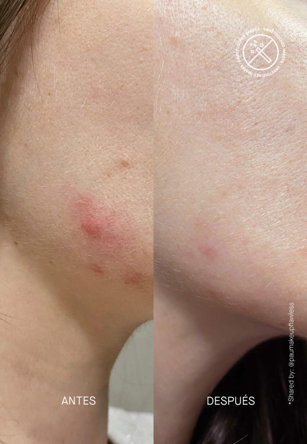 ACNEMY POSTZIT® - Sérum corretor marcas pos-espinhas