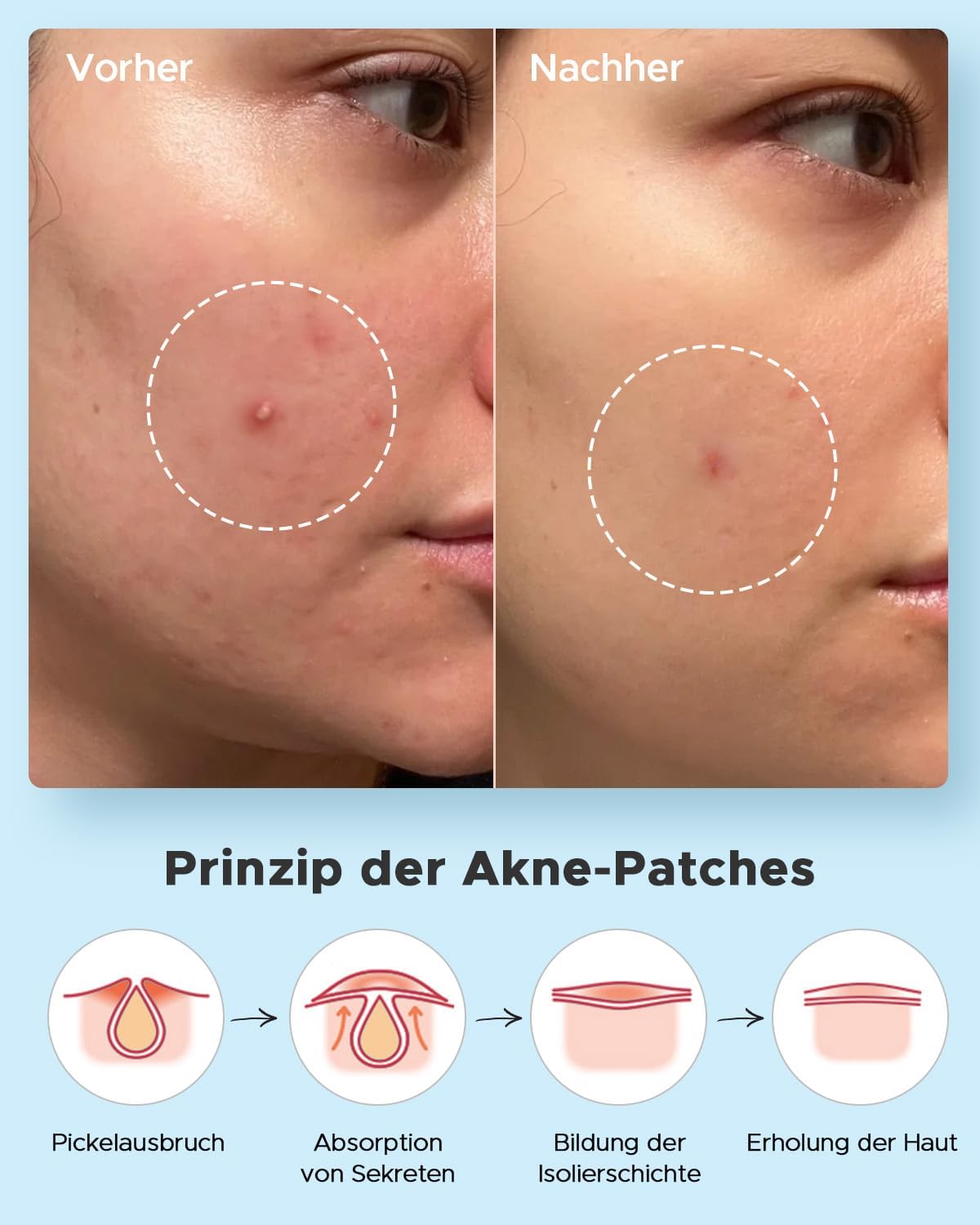 Adesivos Hidrocoloides para Acne 4 Tamanhos Dia e Noite