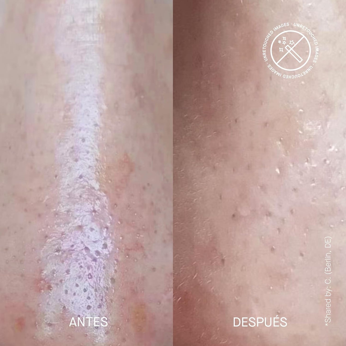 ACNEMY ZITPROOF® NOSE - Adesivos hidrocoloides para nariz