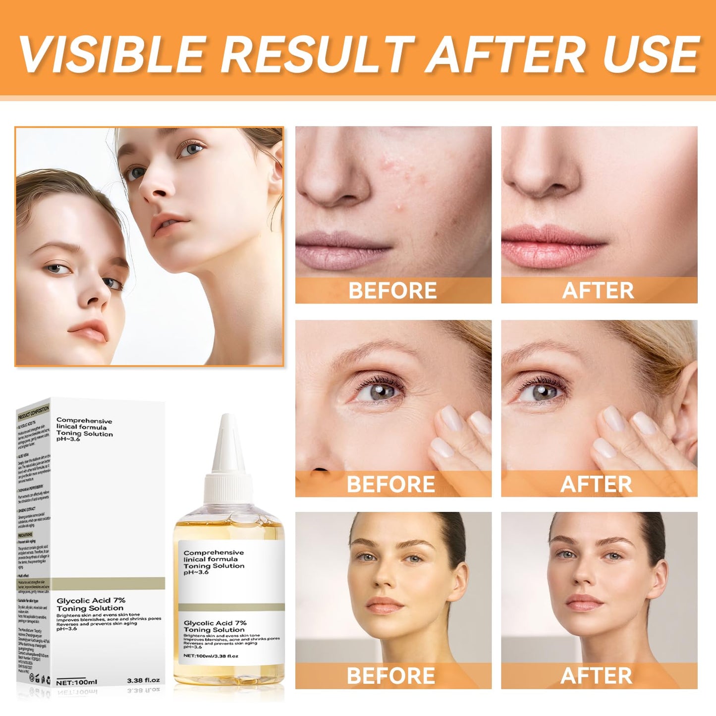 Ácido glicólico 7% Toning Resurfacing Solution, ácido glicólico, adequado para todos os tipos de pele