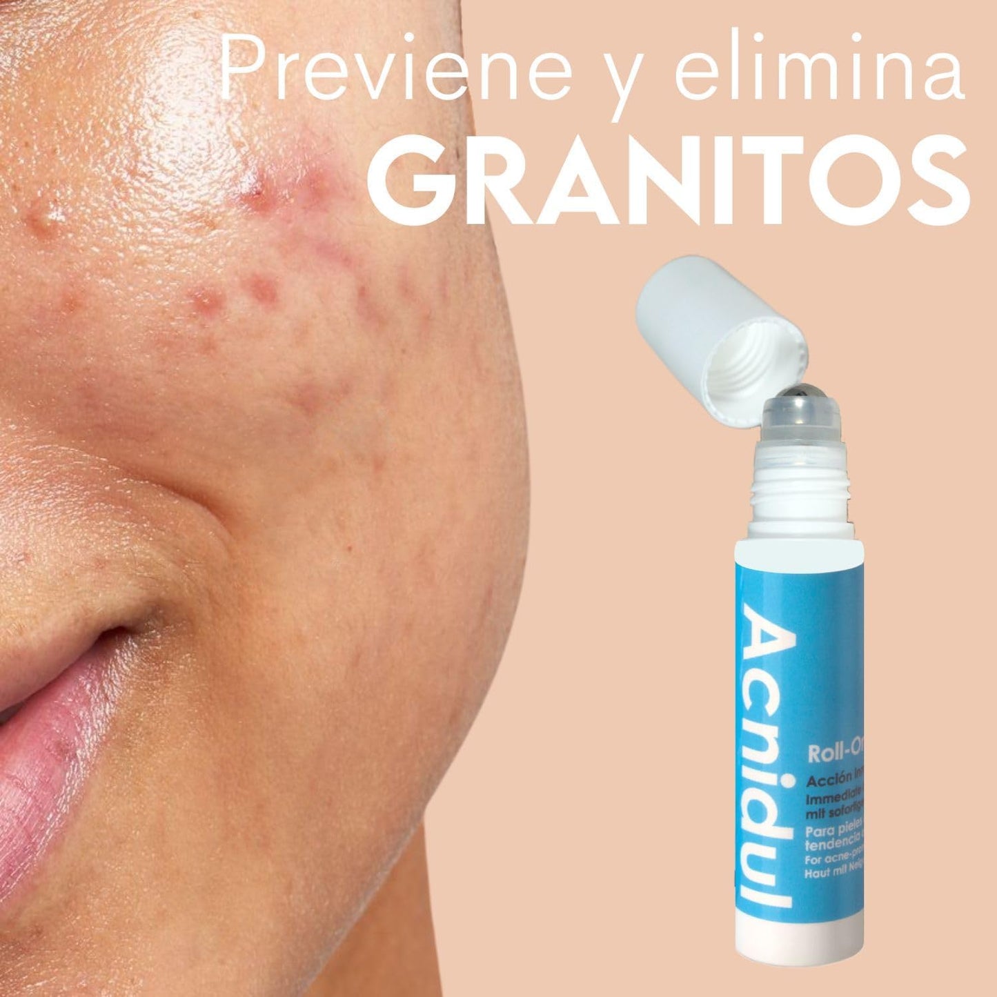 ACNIDUL | Roll-on de ação imediata com ácido glicólico e calêndula | Remova espinhas do seu rosto | 14 ml |