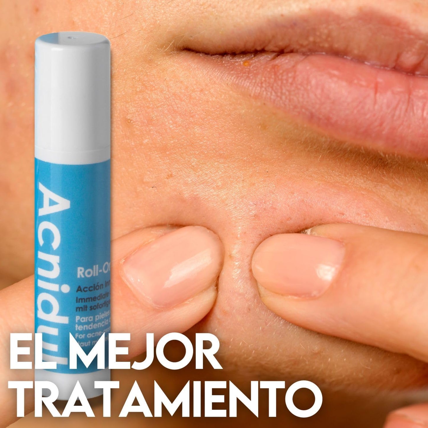 ACNIDUL | Roll-on de ação imediata com ácido glicólico e calêndula | Remova espinhas do seu rosto | 14 ml |