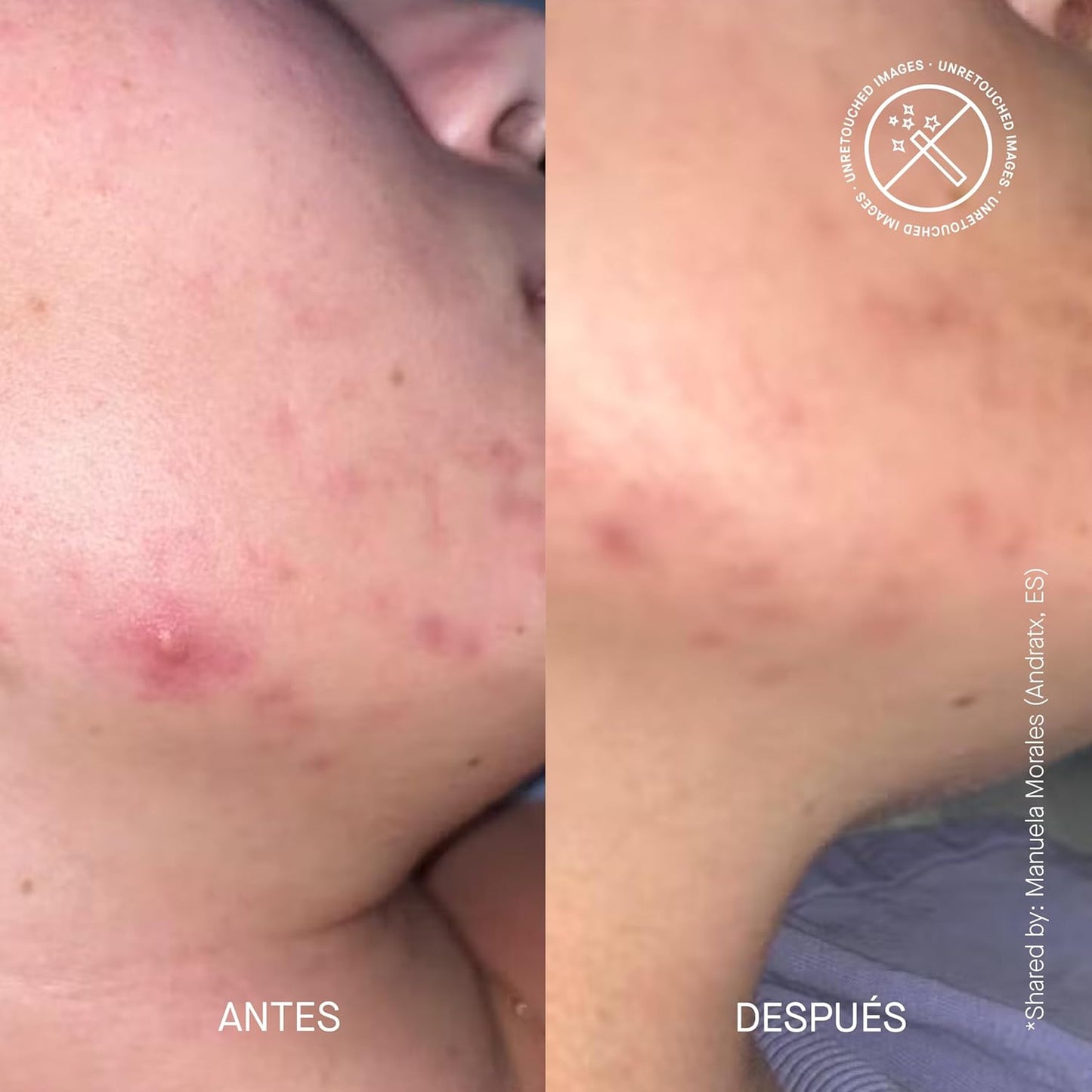 ACNEMY ZITCONTROL® - Tratamento para peles com tendencia acneica