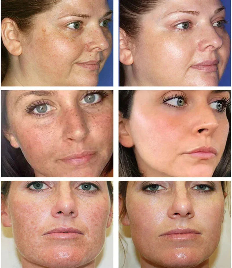 Antes e depois da aplicação do creme clareador com nicotinamida, mostrando melhora na luminosidade e uniformidade da pele