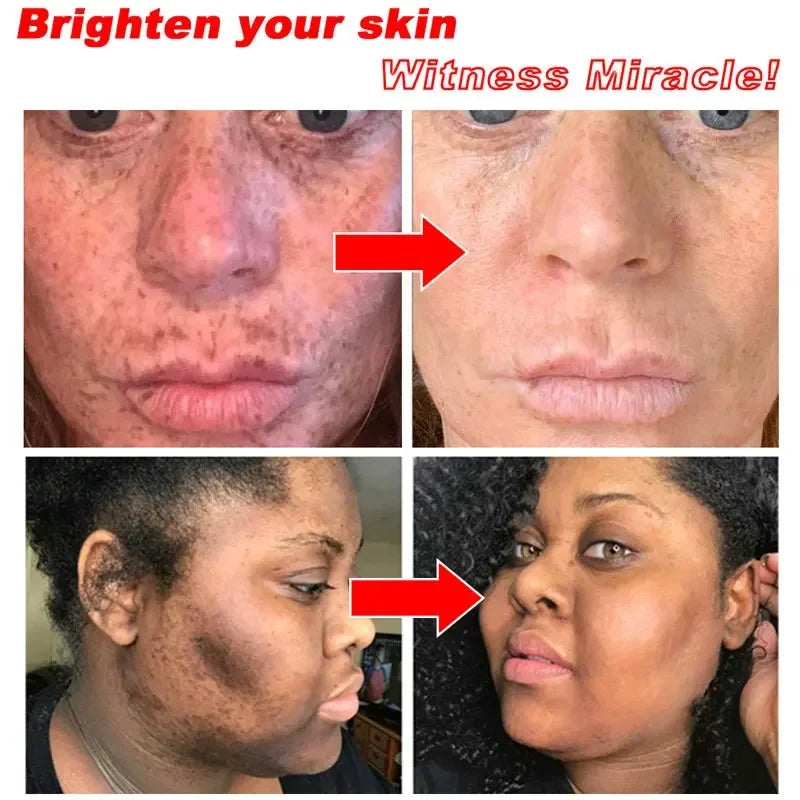 Antes e depois de usar creme clareador com nicotinamida, mostrando pele mais clara e radiante em diferentes tipos de pele.