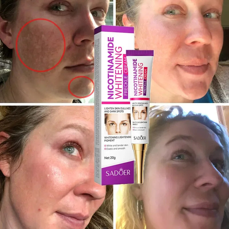 Crème clareador com nicotinamida em embalagem moderna, ao lado de antes e depois de aplicação em pele com manchas.