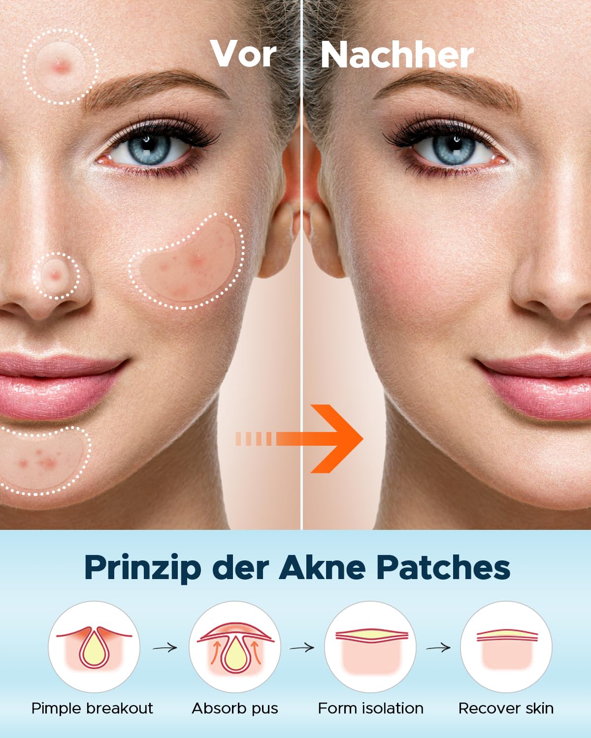 Adesivos para acne efeito rapido LitBear, tratamento com óleo de tea tree e calêndula, em 6 tamanhos