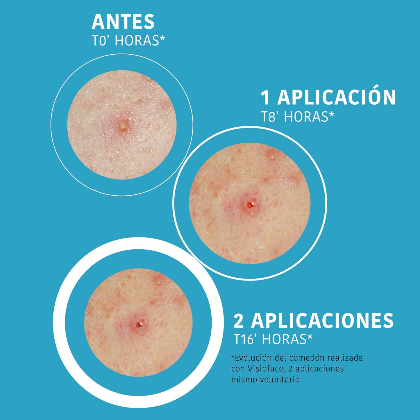 Adesivos para espinhas com ácido salicílico Iroha Nature, redução visível em 8 horas, 18 unidades