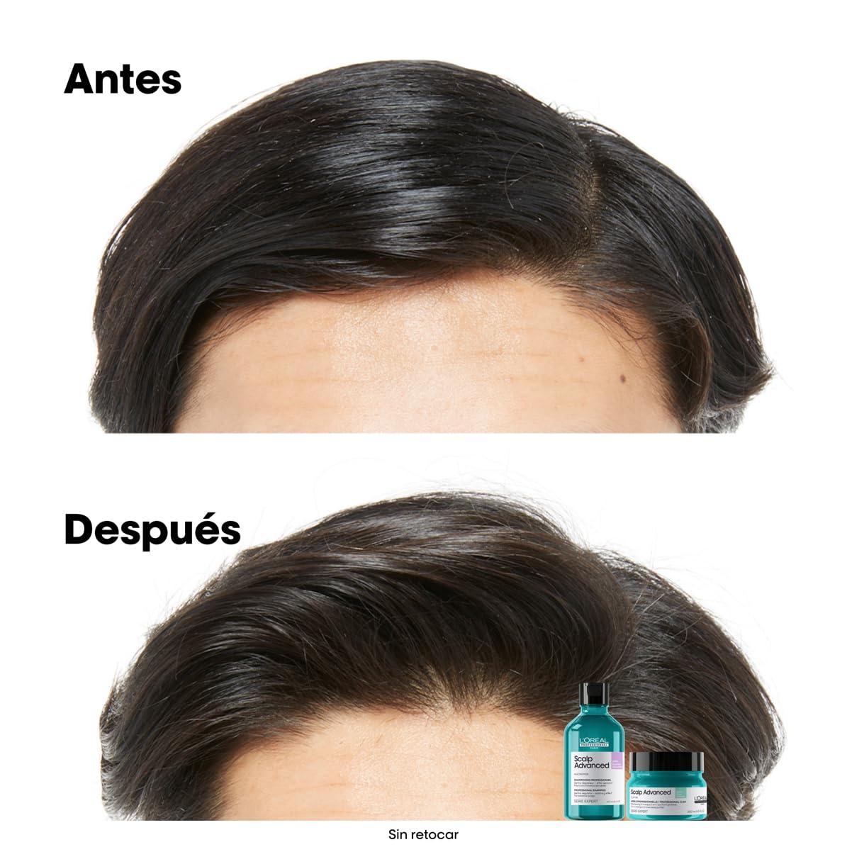 L’Oréal Professionnel, Shampoo Anti-Oleoso Enriquecido com Ingredientes Dermatologicamente Ativos para Couro Cabeludo Oleoso, Scalp Advanced, 300 ml