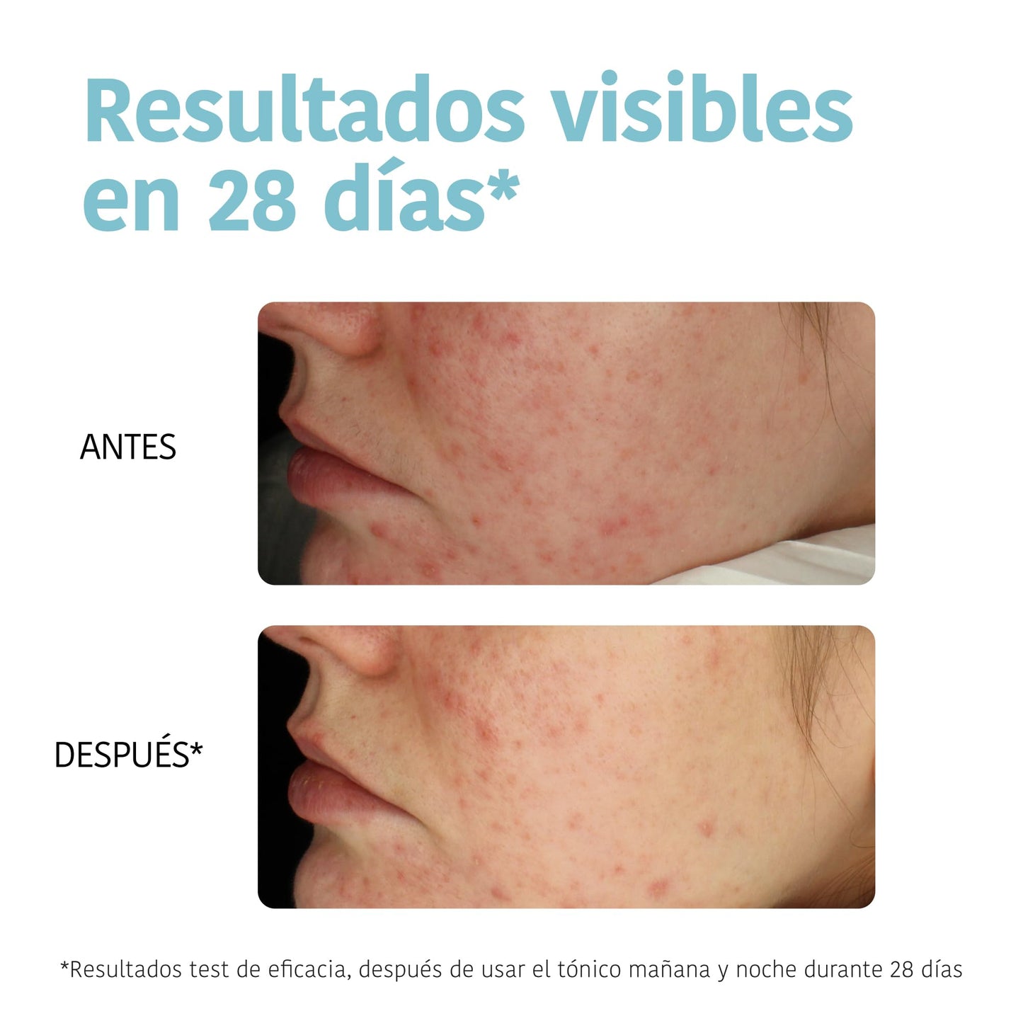 Iroha Nature - Sérum Anti-Imperfeições Ácido Salicílico 2% Niacinamida 3,5%