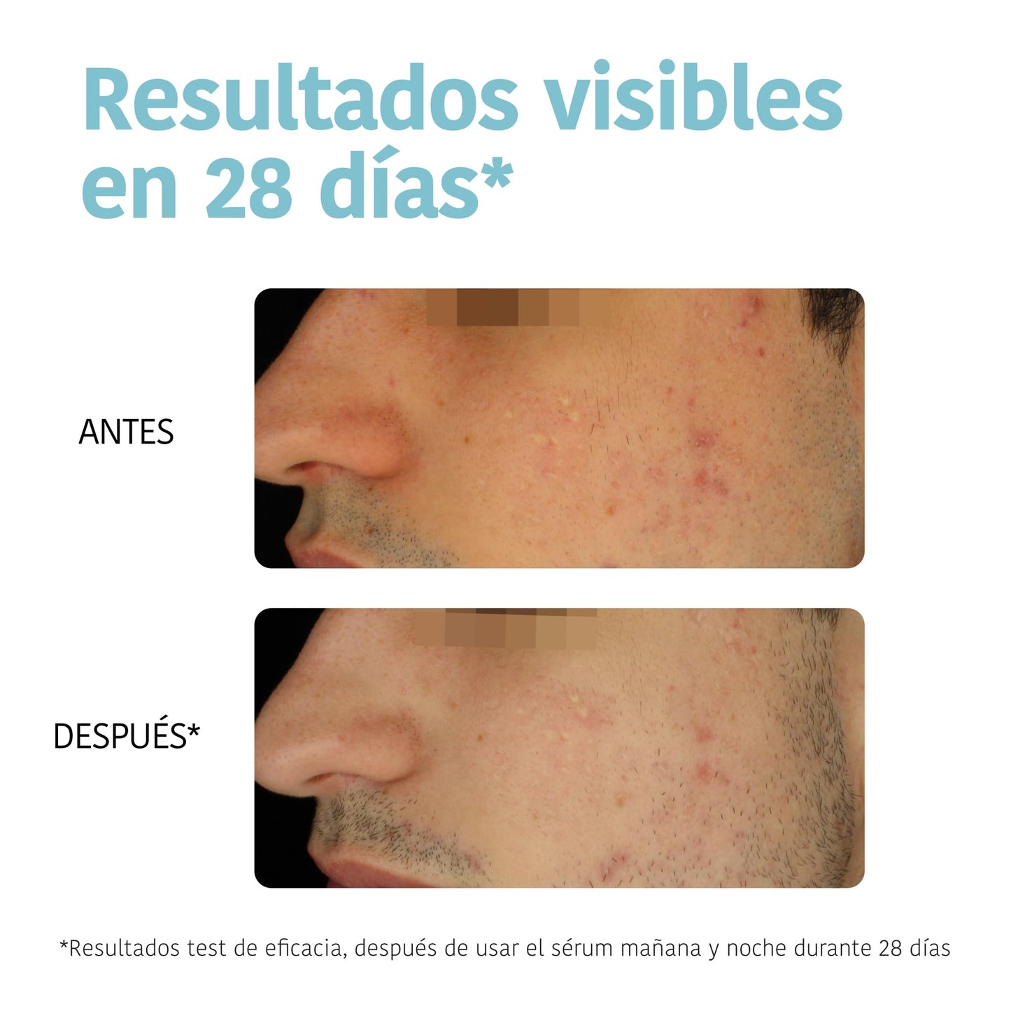 Iroha Nature - Sérum Anti-Imperfeições Ácido Salicílico 2% Niacinamida 3,5%