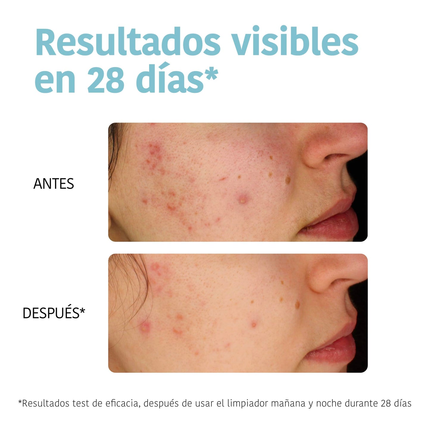Iroha Nature - Sérum Anti-Imperfeições Ácido Salicílico 2% Niacinamida 3,5%