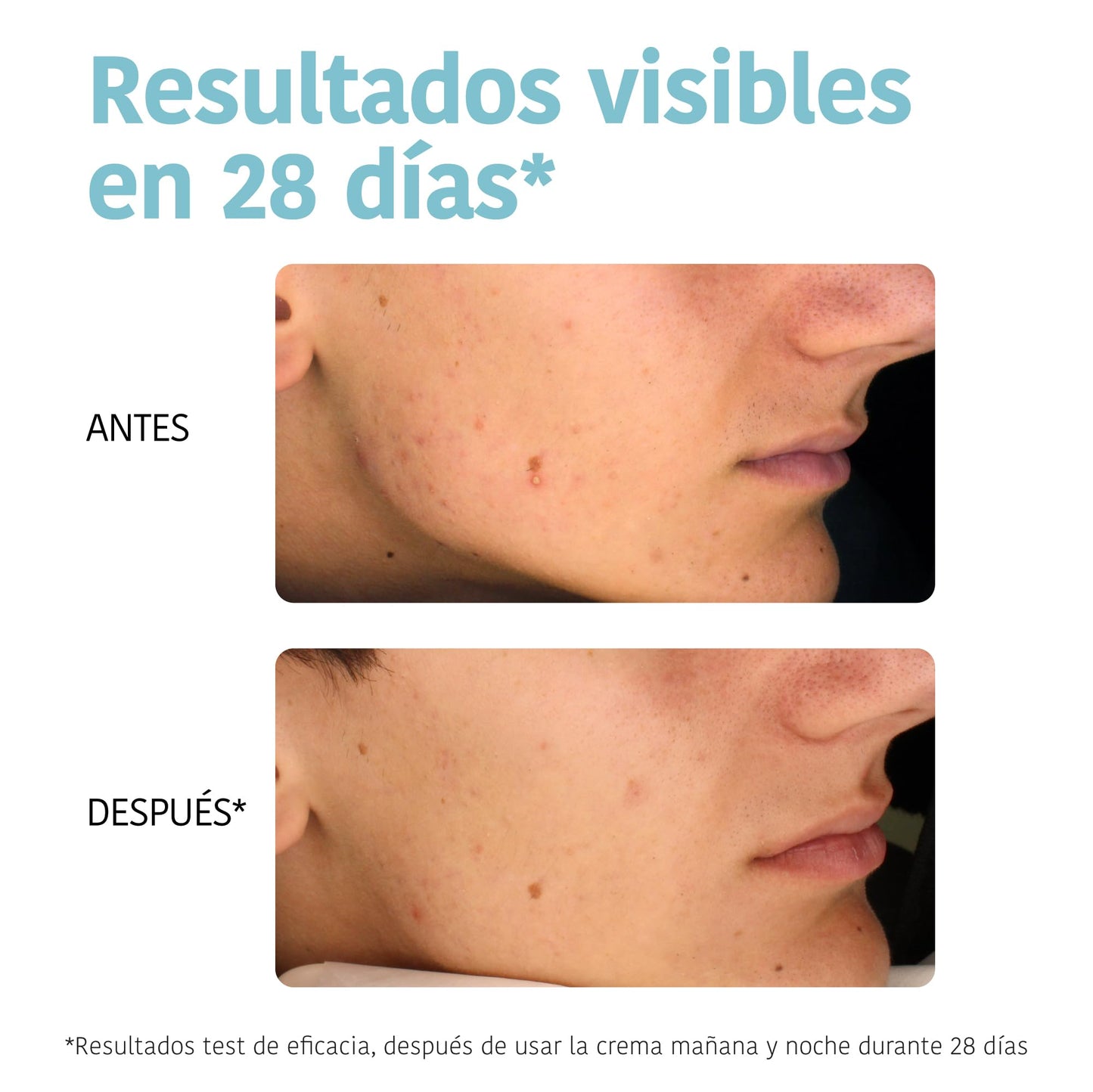 Iroha Nature - Sérum Anti-Imperfeições Ácido Salicílico 2% Niacinamida 3,5%