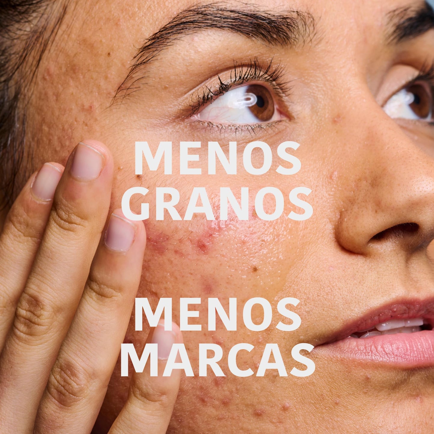 Iroha Nature - Sérum Anti-Imperfeições Ácido Salicílico 2% Niacinamida 3,5%