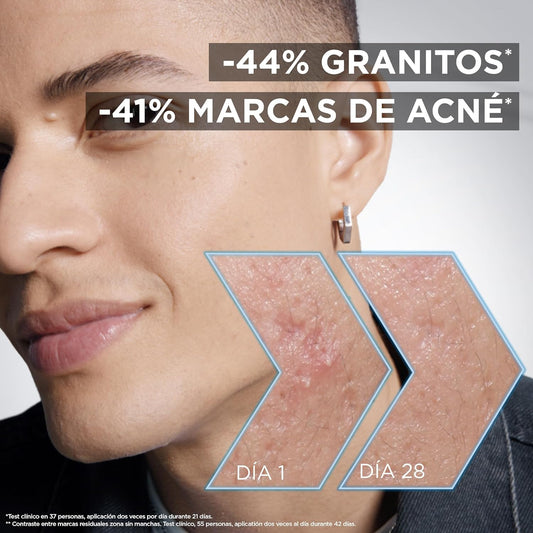 Garnier PureActive Sérum Facial Anti-Imperfeições AHA+BHA com Carbón, antes e depois do uso, mostrando resultados visíveis.
