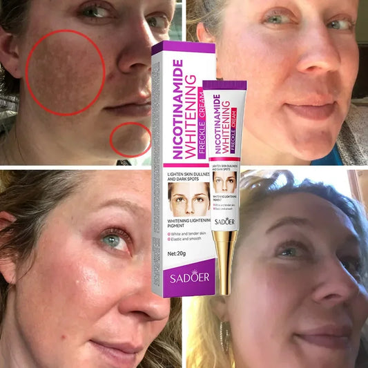 Crème clareador com nicotinamida em embalagem moderna, ao lado de antes e depois de aplicação em pele com manchas.